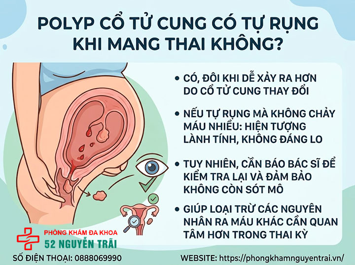 Polyp Cổ Tử Cung Khi Mang Thai Có Nguy Hiểm Không? 6 Polyp có tự rụng khi mang thai không?