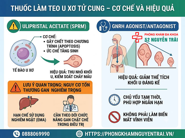 Điều Trị U Xơ Tử Cung Không Cần Phẫu Thuật 3 Thuốc làm teo u xơ tử cung cơ chế và hiệu quả thực tế