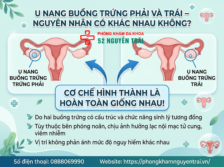 Nguyên nhân u nang buồng trứng và các yếu tố nguy cơ 5 U nang buồng trứng phải và trái – nguyên nhân có khác nhau không?