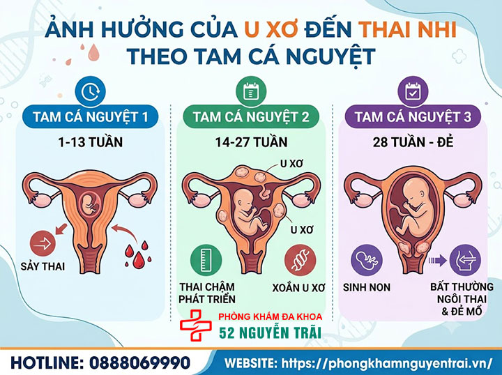 U Xơ Tử Cung Khi Mang Thai Có Nguy Hiểm Không? 2 U xơ ảnh hưởng đến thai nhi như thế nào theo từng tam cá nguyệt?