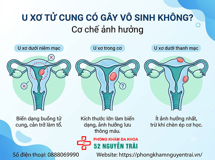 U Xơ Tử Cung Có Nguy Hiểm Không? Biến Chứng Cần Biết 5 U xơ có gây vô sinh không? Cơ chế ảnh hưởng thụ thai