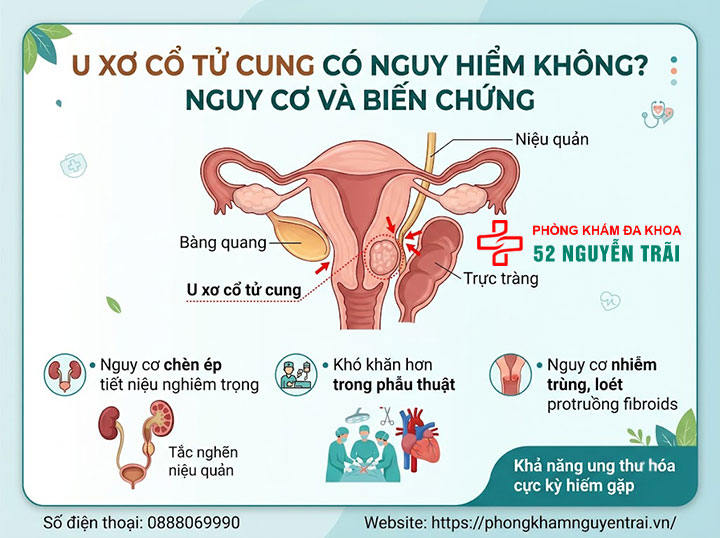 U Xơ Cổ Tử Cung Là Gì? Dấu Hiệu Và Cách Điều Trị 3 U xơ cổ tử cung có nguy hiểm không? Nguy cơ và biến chứng