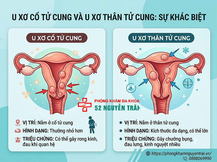 U Xơ Cổ Tử Cung Là Gì? Dấu Hiệu Và Cách Điều Trị 1 U xơ cổ tử cung là gì? Khác gì với u xơ thân tử cung?