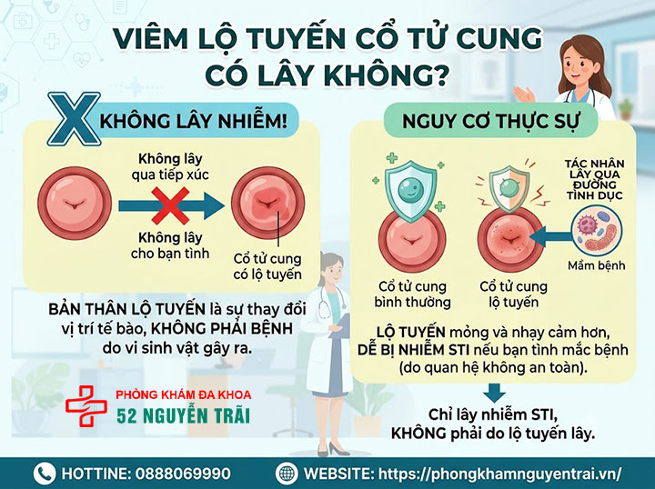 Viêm Lộ Tuyến Cổ Tử Cung Có Nguy Hiểm Không? 3 Viêm lộ tuyến cổ tử cung có lây không? Qua đường nào?
