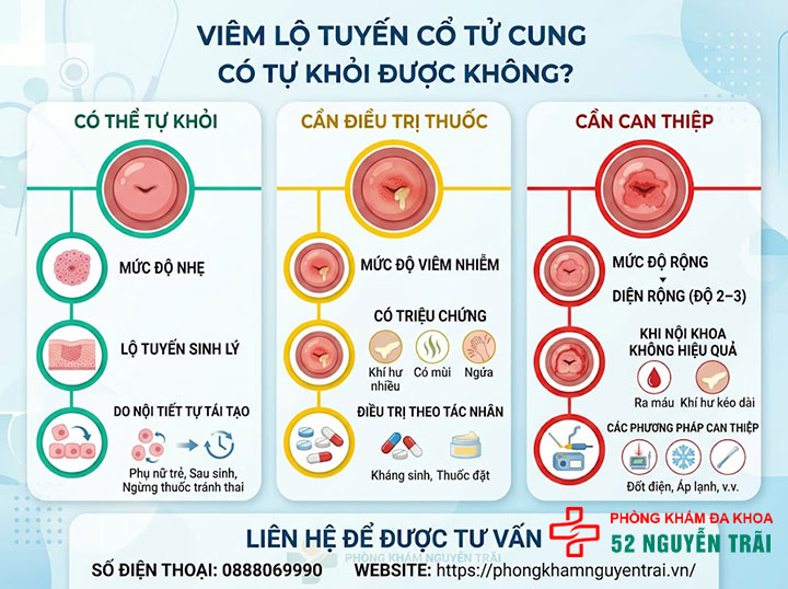 Viêm Lộ Tuyến Cổ Tử Cung Có Nguy Hiểm Không? 2 Viêm lộ tuyến có tự khỏi được không? Mức độ nào tự hết, mức độ nào cần điều trị