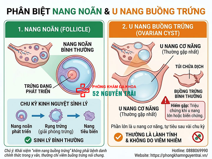 Viêm nang, viêm đa nang, viêm tai vòi buồng trứng: Phân biệt 1 Viêm nang buồng trứng là gì – phân biệt với u nang