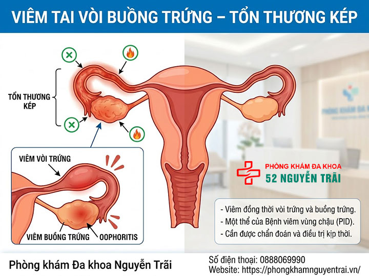 Viêm nang, viêm đa nang, viêm tai vòi buồng trứng: Phân biệt 3 Viêm tai vòi buồng trứng – tổn thương kép
