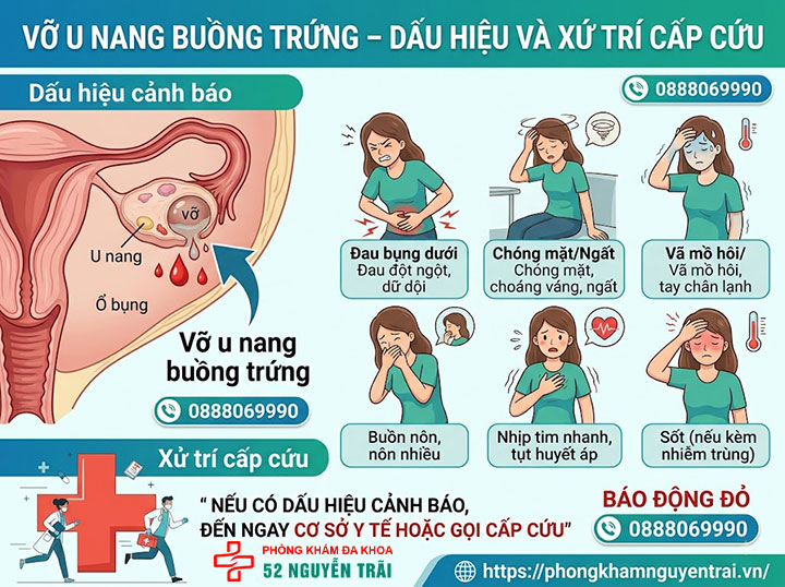 Dấu hiệu u nang buồng trứng và có nguy hiểm không? 5 Vỡ u nang buồng trứng – Dấu hiệu và xử trí cấp cứu