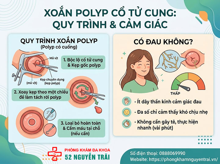 Cắt, Xoắn, Đốt Polyp Cổ Tử Cung: Phương Pháp, Quy Trình 1 Xoắn polyp là gì? Quy trình, có đau không?