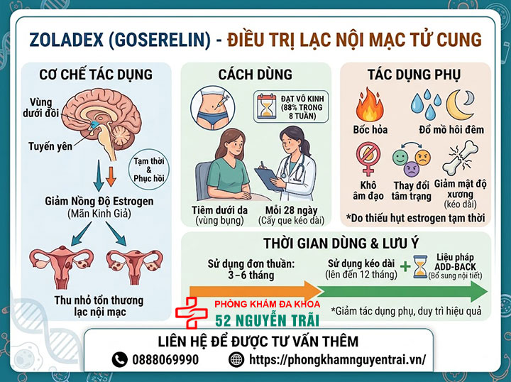 Điều Trị Lạc Nội Mạc Tử Cung: Thuốc Và Phác Đồ 3 Zoladex (GnRH agonist) điều trị lạc nội mạc tử cung